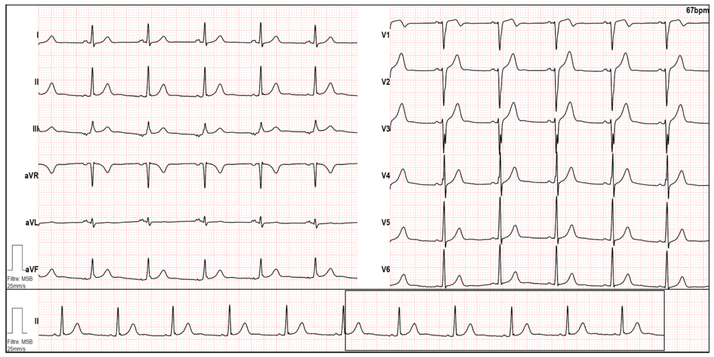 Électrocardiogramme normal
