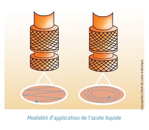 Modalité d'application de l'azote liquide